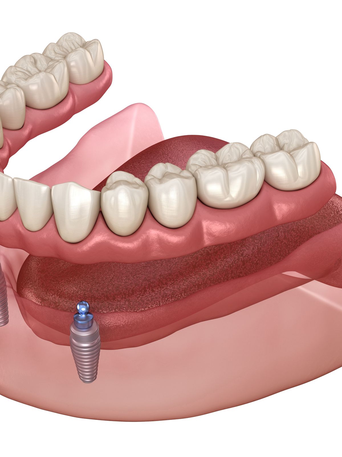 Implant Retained Denture featured image