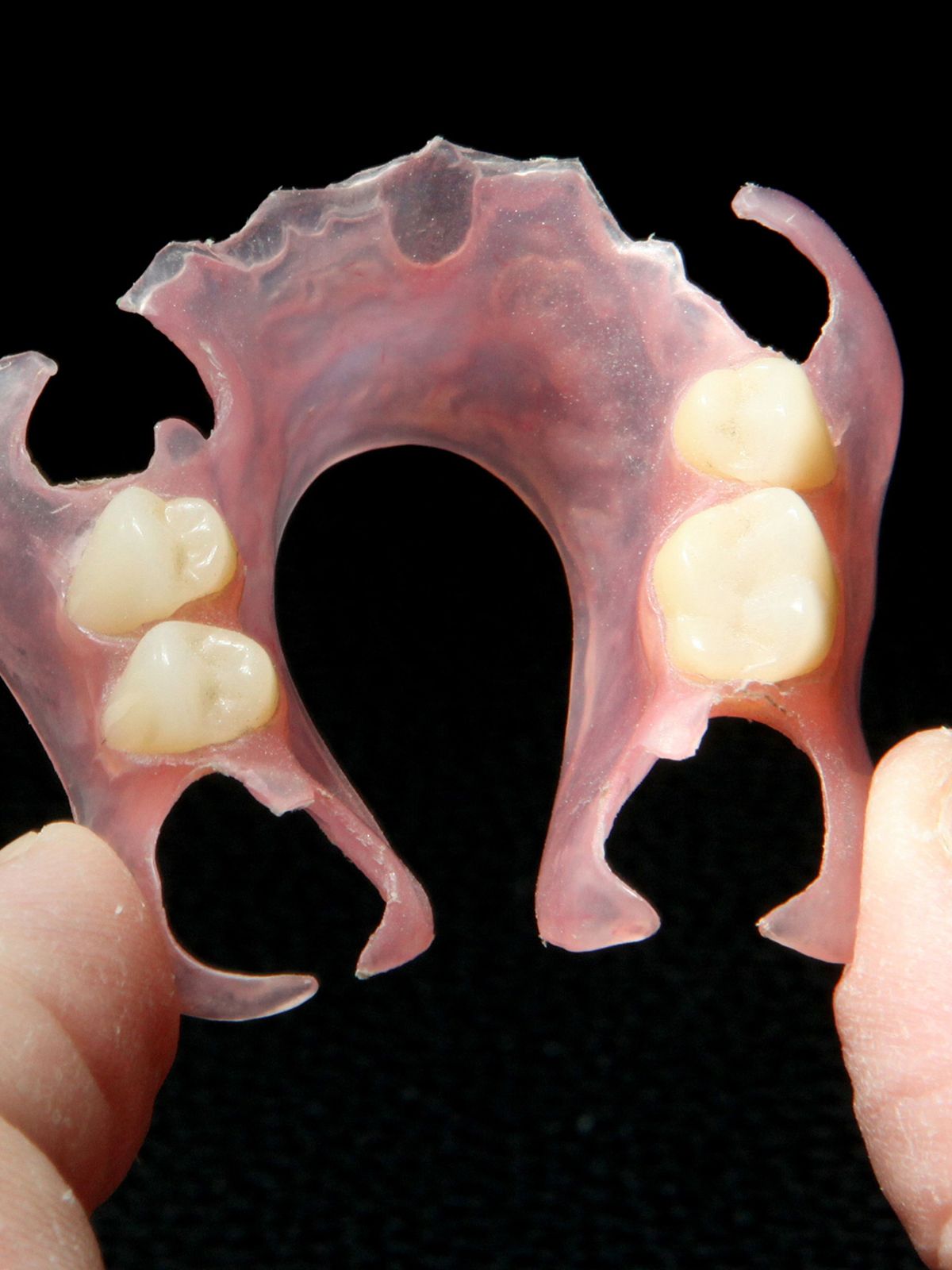 Flexible Partial Denture featured image