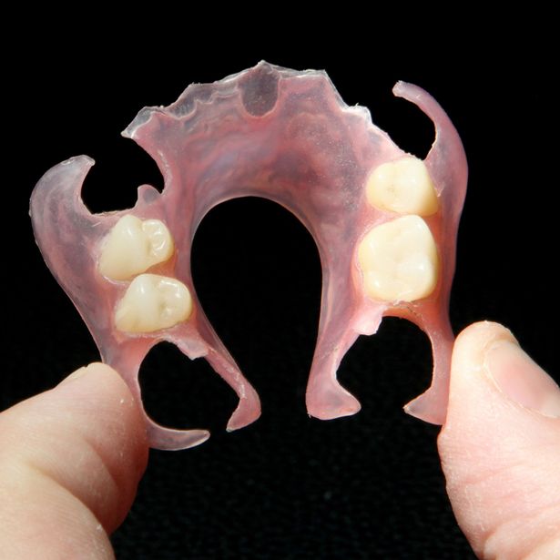 Newly done flexible partial denture